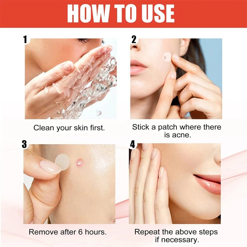 144 Adesivos Invisíveis para Acne Facial, Adesivos Anti-inflamatórios para Cuidados com a Pele, Adesivos Absorventes para Cobrir Acne