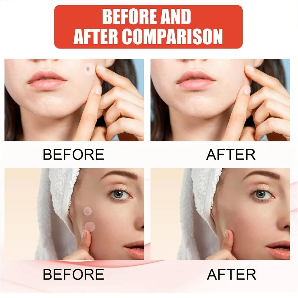 144 Adesivos Invisíveis para Acne Facial, Adesivos Anti-inflamatórios para Cuidados com a Pele, Adesivos Absorventes para Cobrir Acne