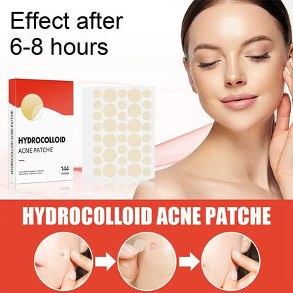 144 Adesivos Invisíveis para Acne Facial, Adesivos Anti-inflamatórios para Cuidados com a Pele, Adesivos Absorventes para Cobrir Acne