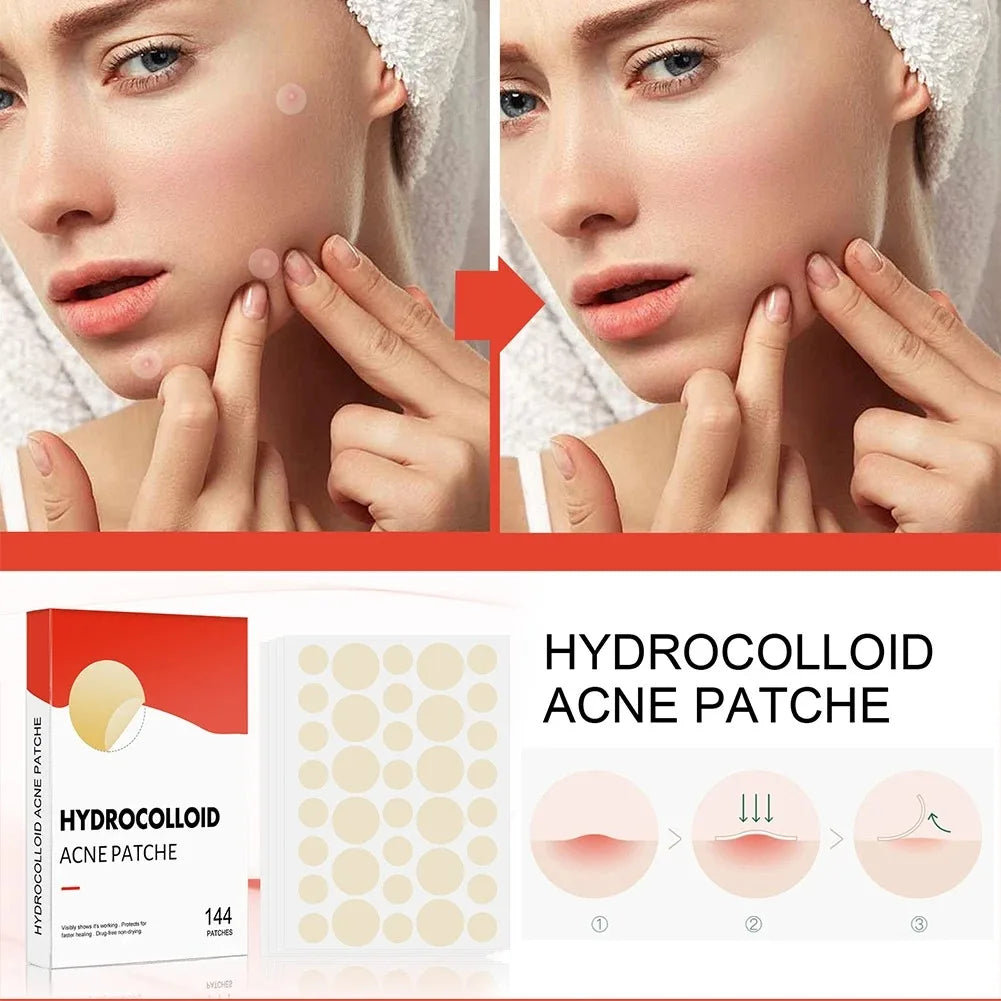 144 Adesivos Invisíveis para Acne Facial, Adesivos Anti-inflamatórios para Cuidados com a Pele, Adesivos Absorventes para Cobrir Acne