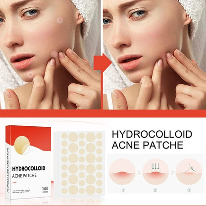 144 Adesivos Invisíveis para Acne Facial, Adesivos Anti-inflamatórios para Cuidados com a Pele, Adesivos Absorventes para Cobrir Acne